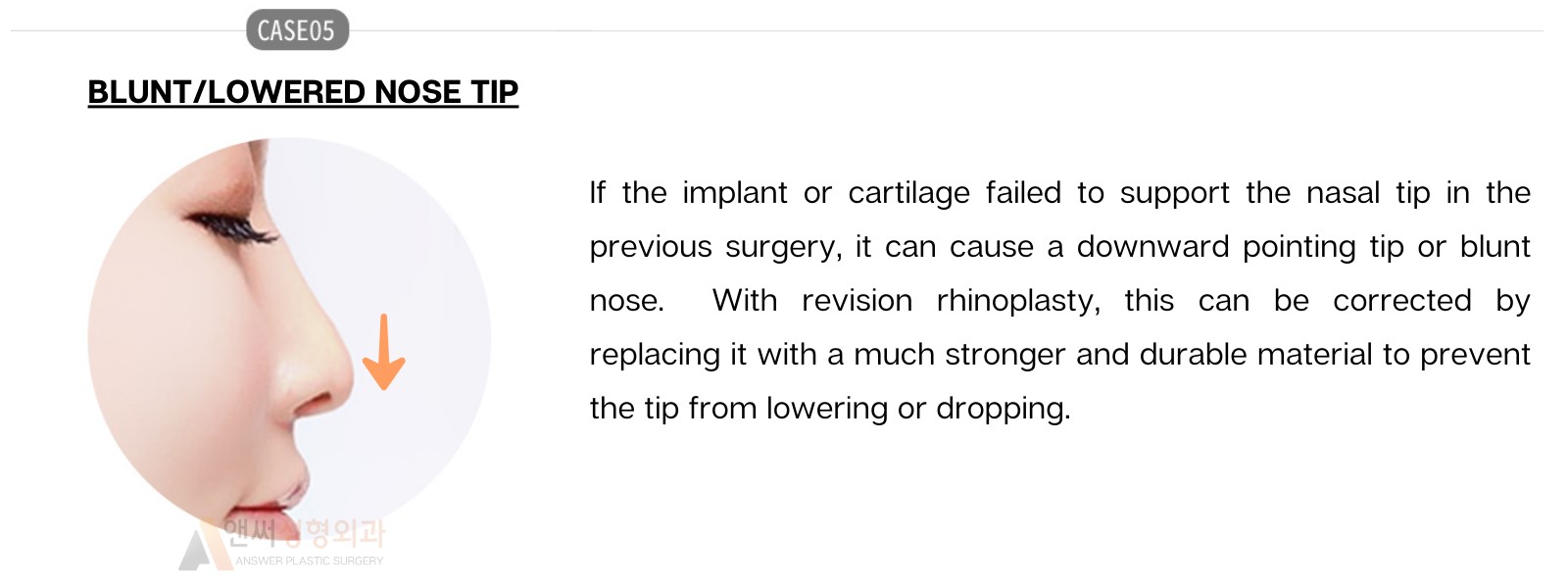 Nose Revision Surgery Nose Revision Surgery