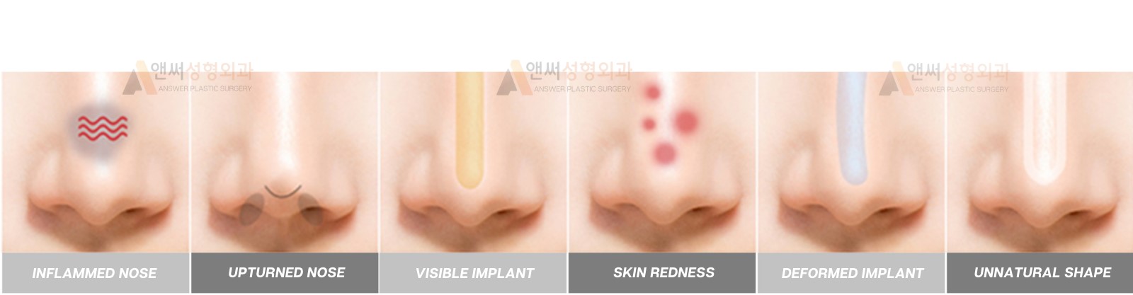 Nose Revision Surgery Nose Revision Surgery