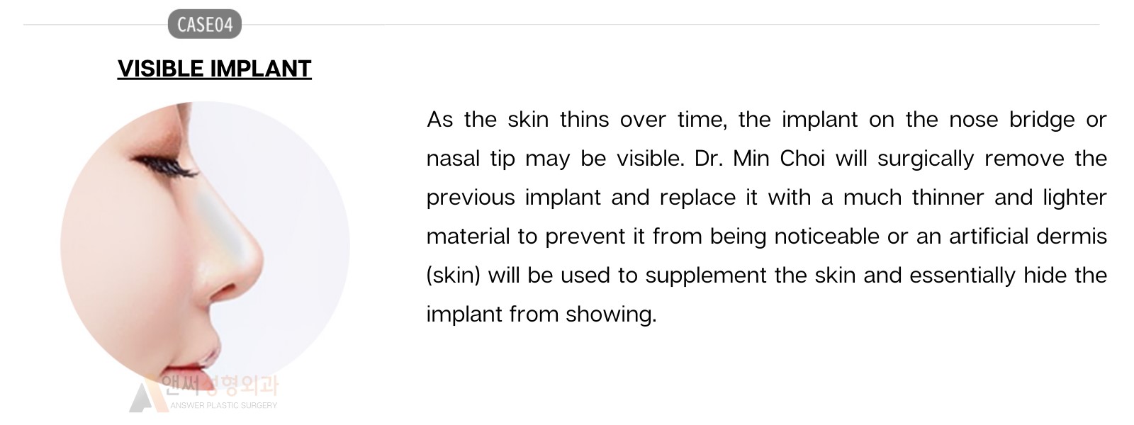 Nose Revision Surgery Nose Revision Surgery
