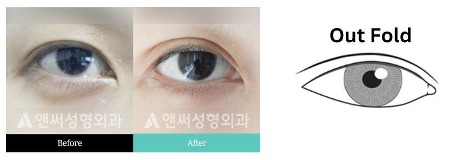 Partial Incisional Double Eyelid Surgery  