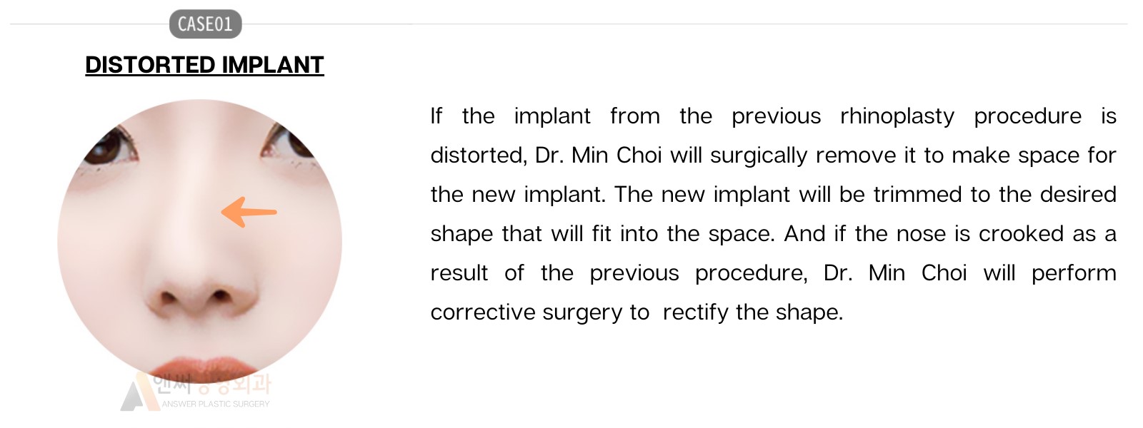Nose Revision Surgery Nose Revision Surgery