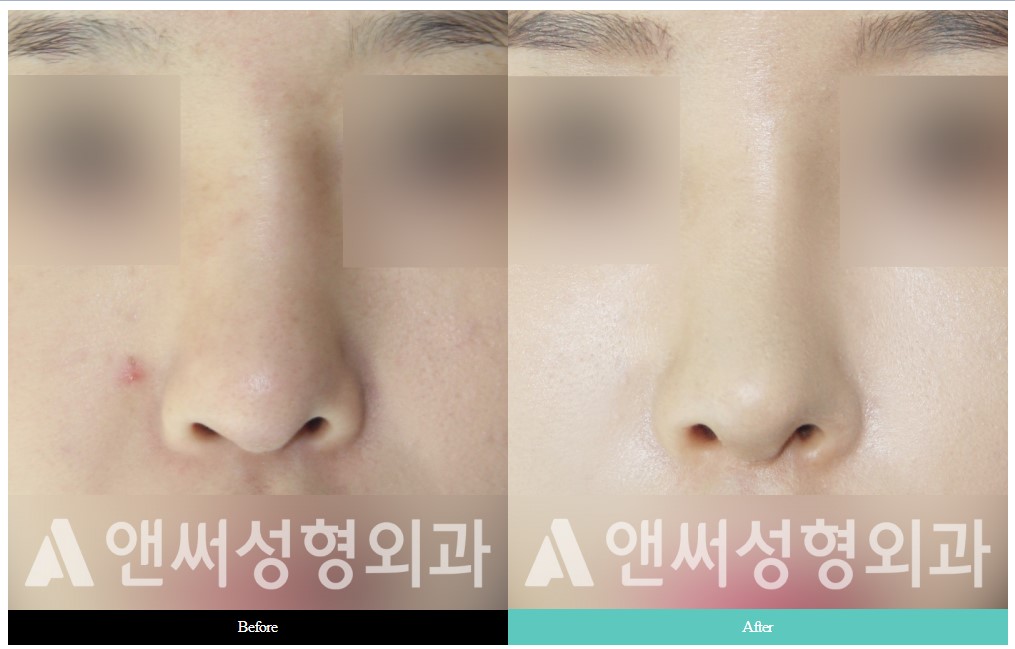 Curved Nose Rhinoplasty Curved Nose Rhinoplasty