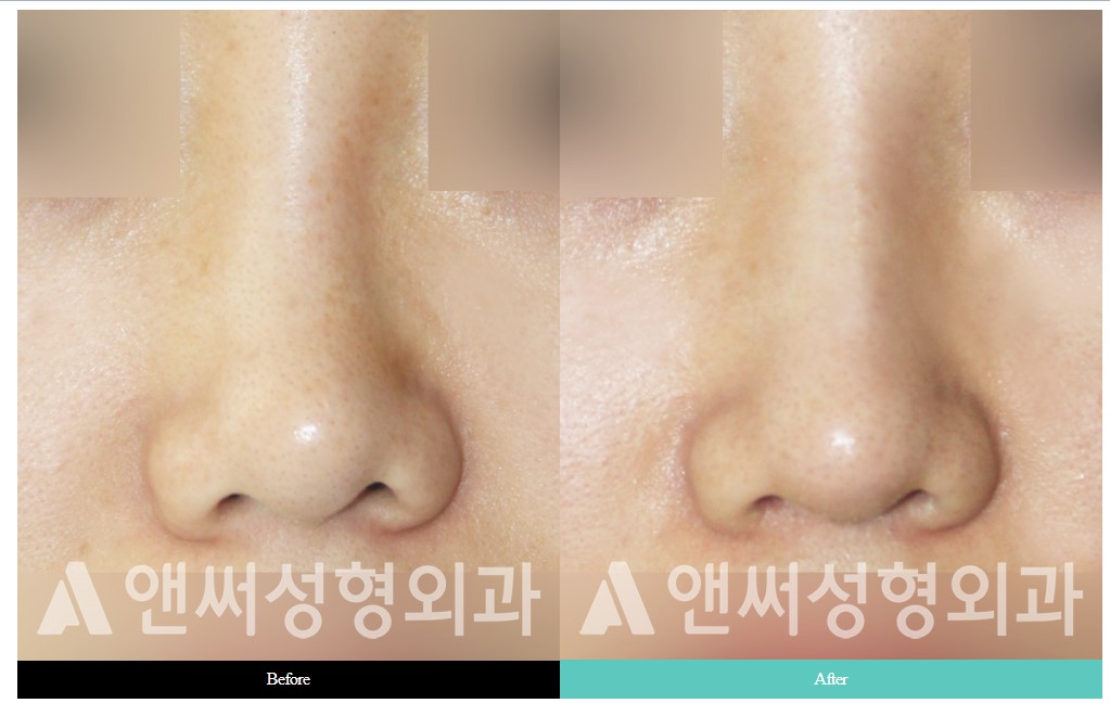 Curved Nose Rhinoplasty Curved Nose Rhinoplasty