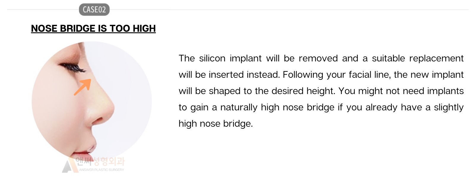Nose Revision Surgery Nose Revision Surgery