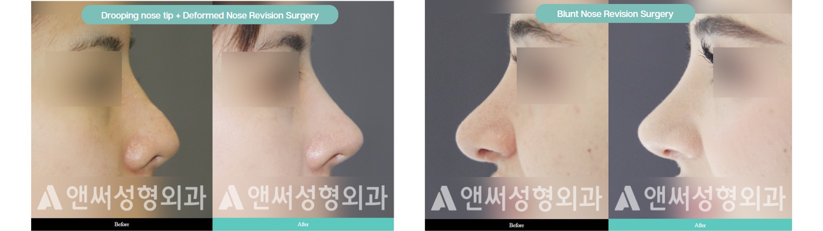 Nose Revision Surgery Nose Revision Surgery