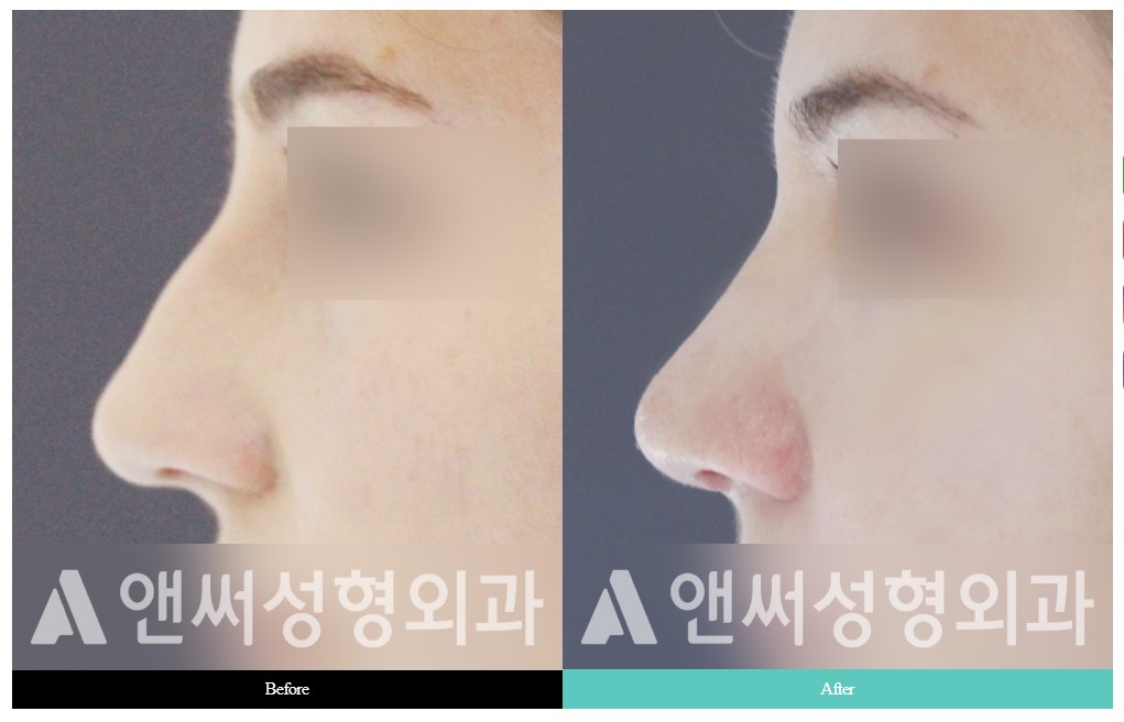 Hump Nose Removal Hump Nose Removal