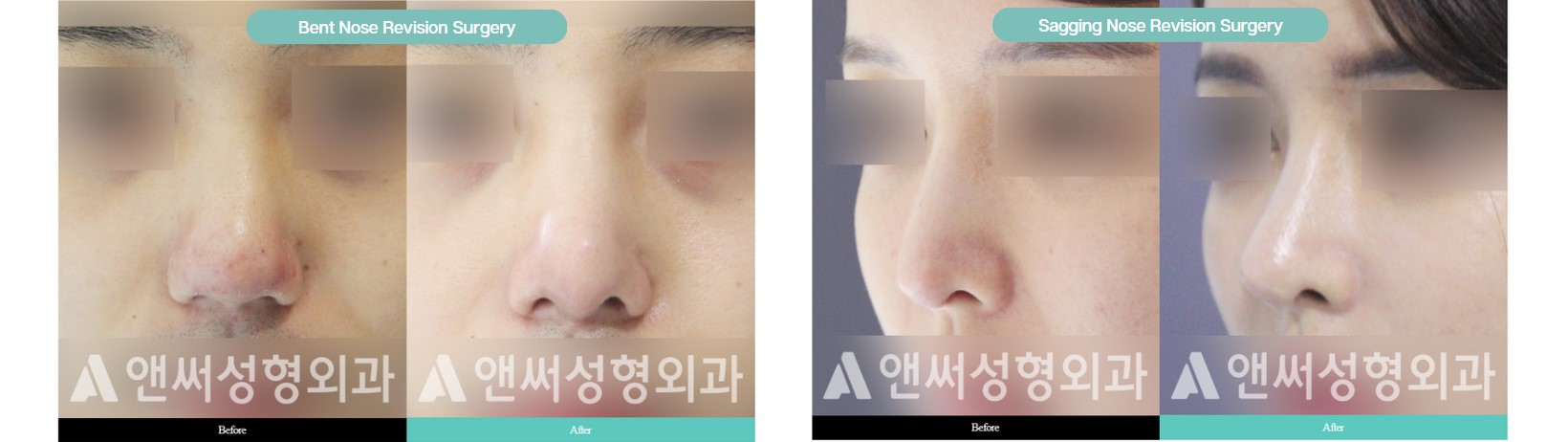 Nose Revision Surgery Nose Revision Surgery