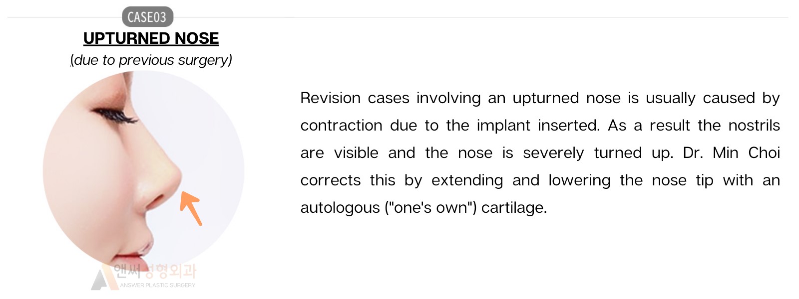 Nose Revision Surgery Nose Revision Surgery