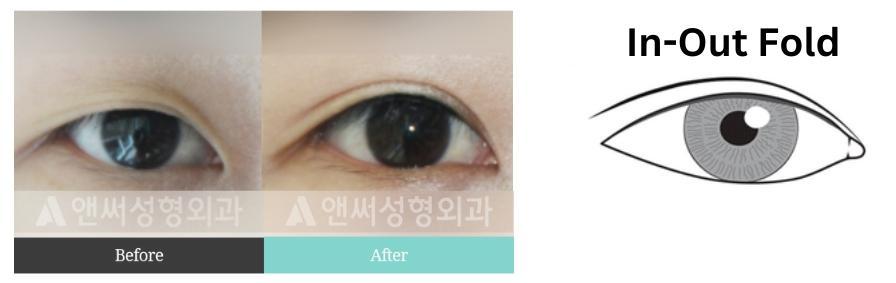 Partial Incisional Double Eyelid Surgery  