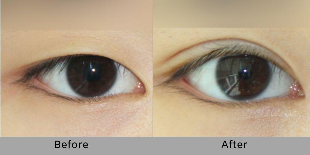Non-incisional Double Eyelid Surgery  