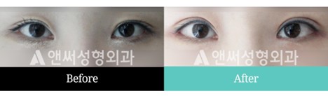 Revision Eye Surgery