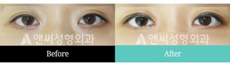 Revision Eye Surgery