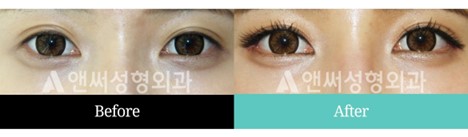 Revision Eye Surgery