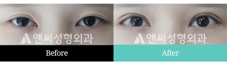Revision Eye Surgery
