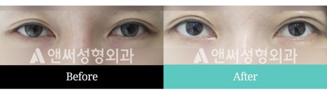 Revision Eye Surgery