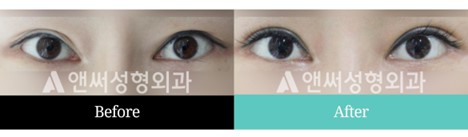 Revision Eye Surgery