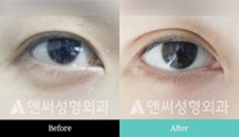 Revision Eye Surgery