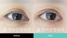 Revision Eye Surgery