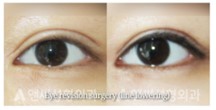 Revision Eye Surgery