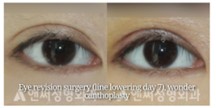 Revision Eye Surgery