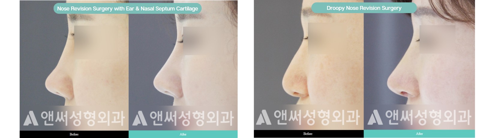 Nose Revision Surgery Nose Revision Surgery