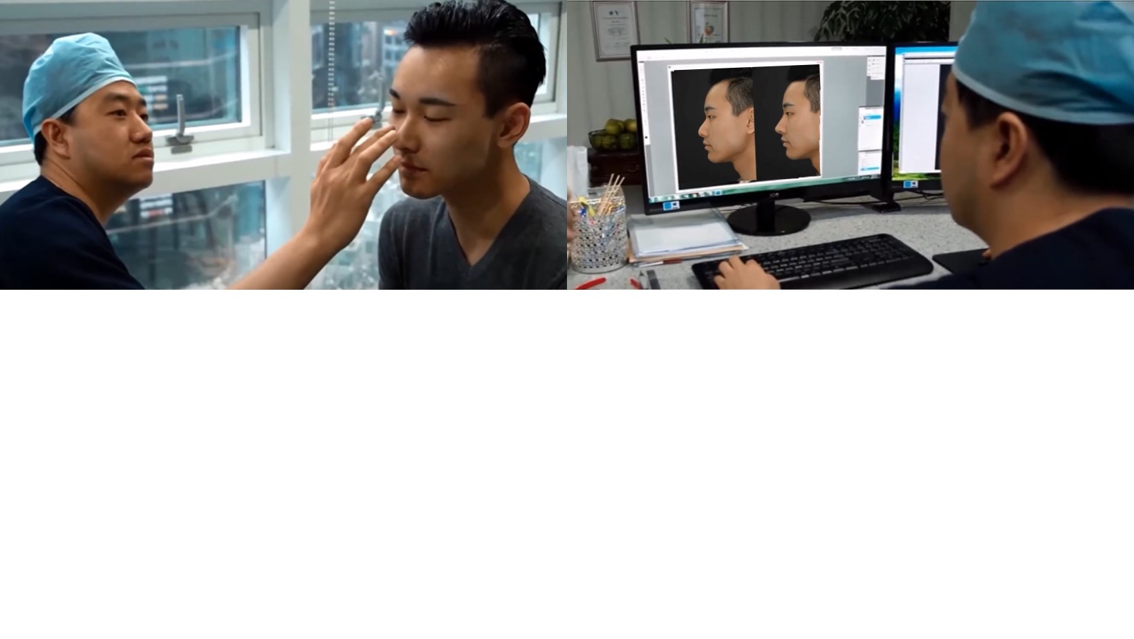 Curved Nose Rhinoplasty Curved Nose Rhinoplasty