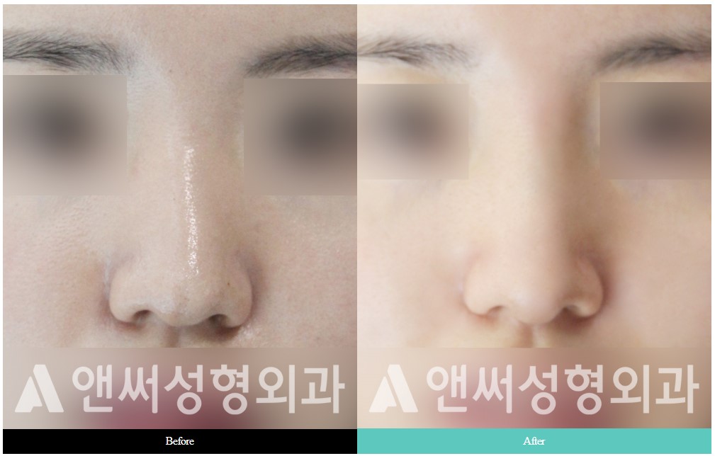 Curved Nose Rhinoplasty Curved Nose Rhinoplasty