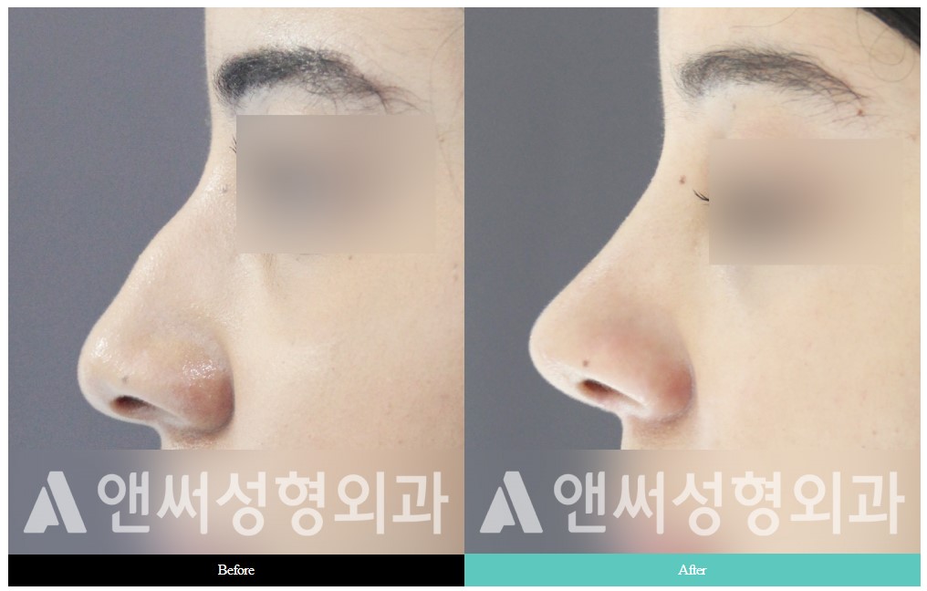 Hump Nose Removal Hump Nose Removal