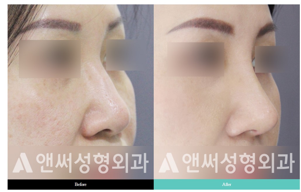 Hump Nose Removal Hump Nose Removal