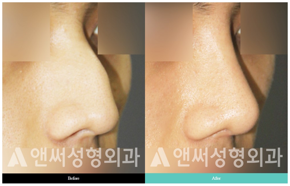 Hump Nose Removal Hump Nose Removal