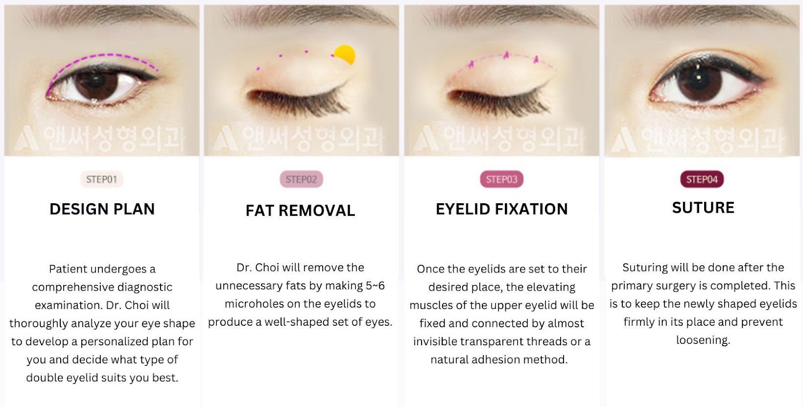 Non-incisional Double Eyelid Surgery  