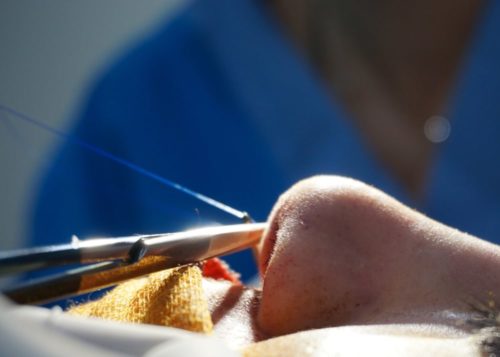 Rhinoplasty in Korea – Procedure, Recovery & Cost in Korea