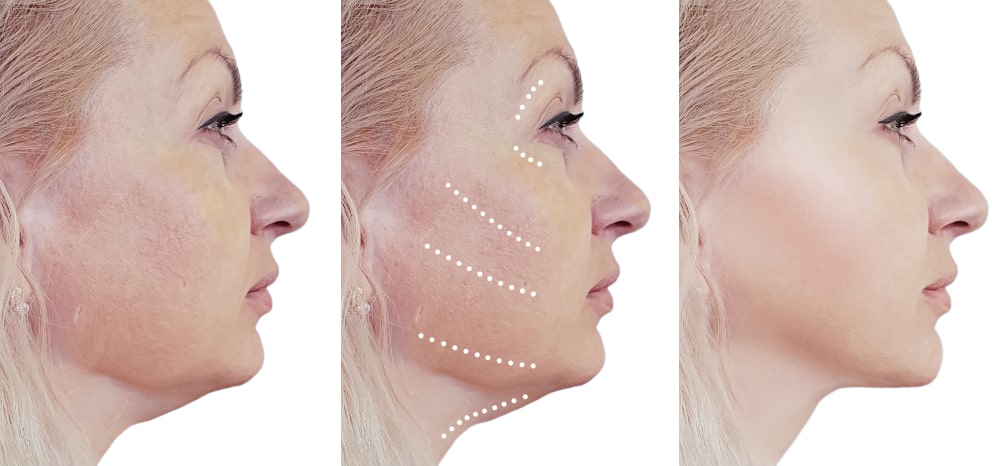 neck lifting result