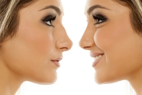 Rhinoplasty in Korea – Procedure, Recovery & Cost in Korea