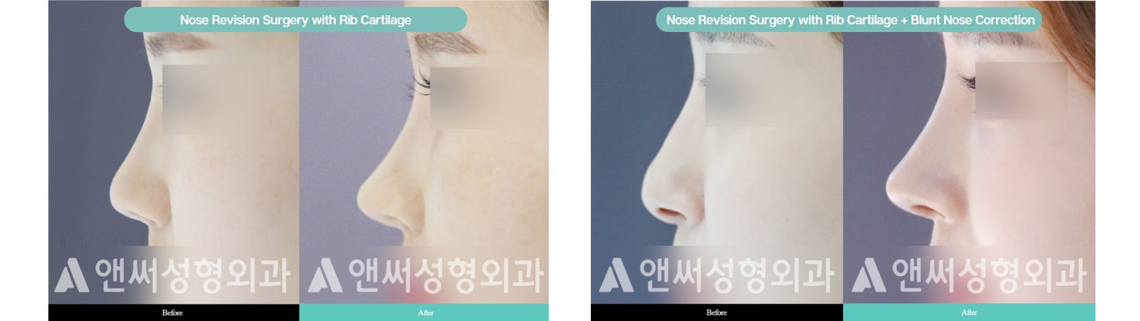 Nose Revision Surgery Nose Revision Surgery