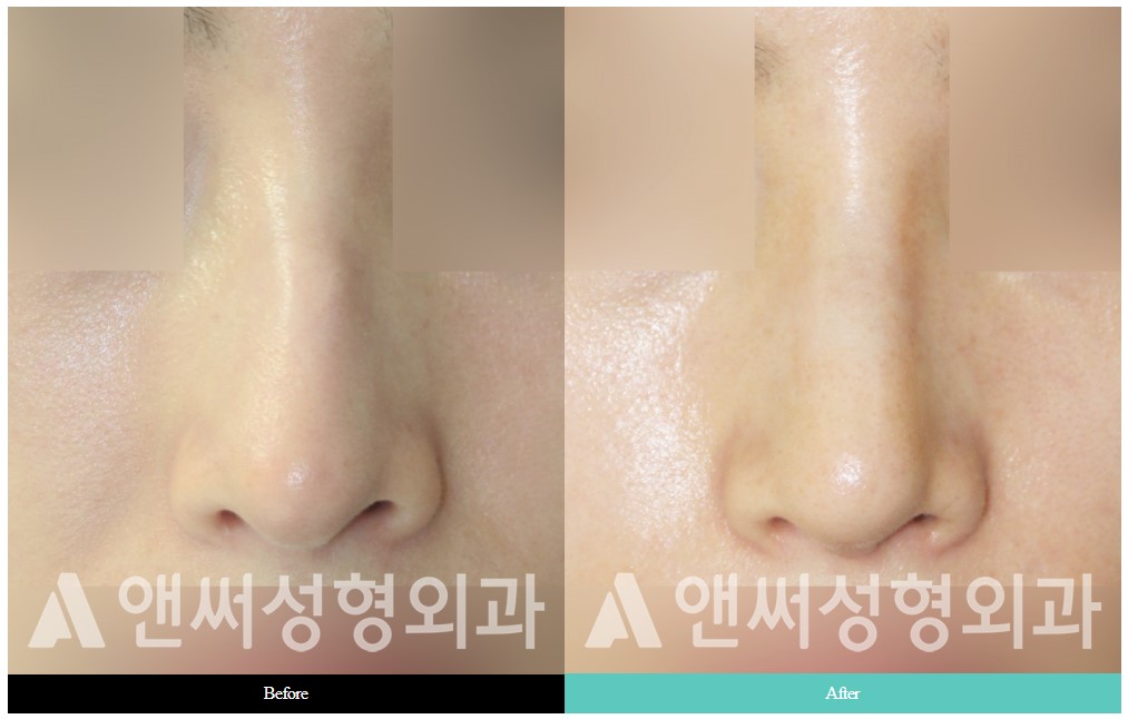 Curved Nose Rhinoplasty Curved Nose Rhinoplasty
