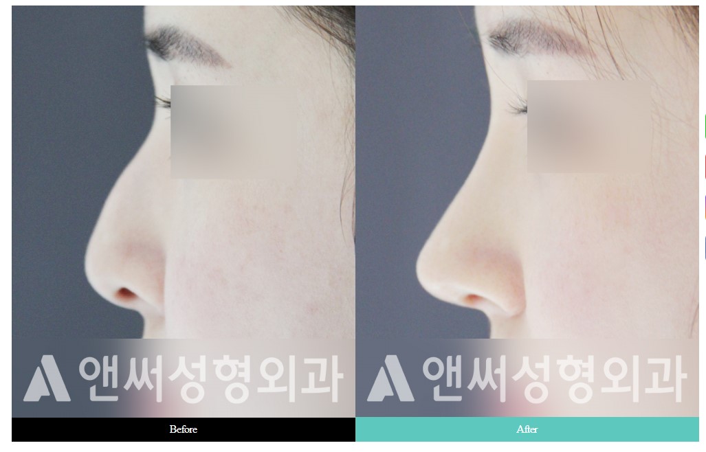 Hump Nose Removal Hump Nose Removal