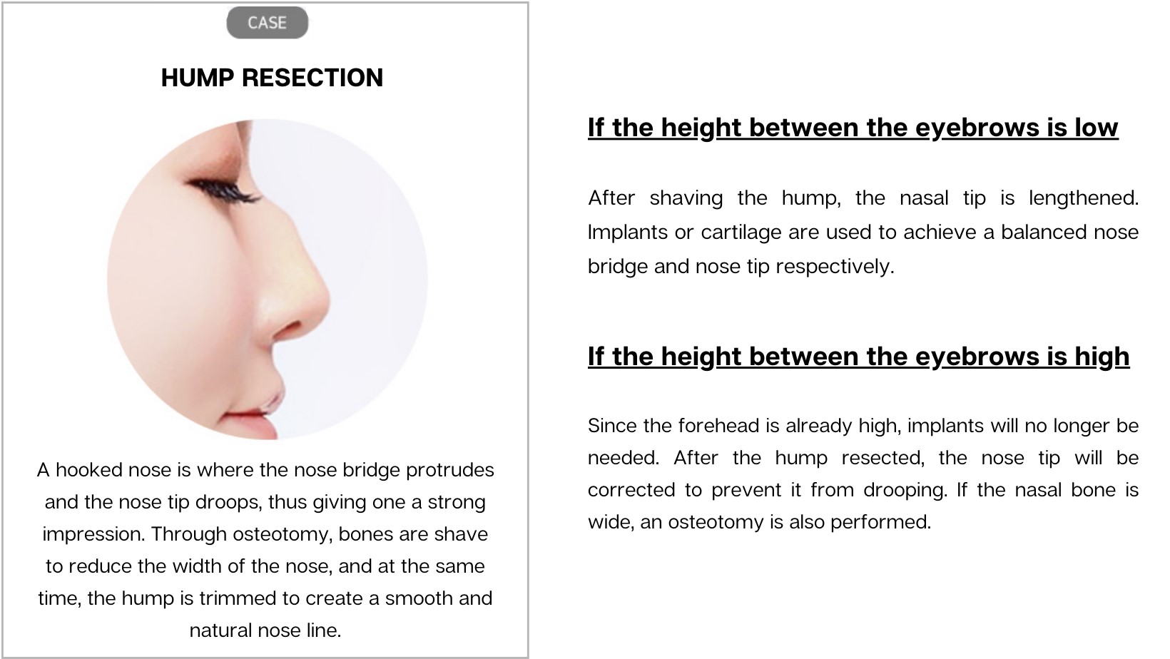 Hump Nose Removal Hump Nose Removal
