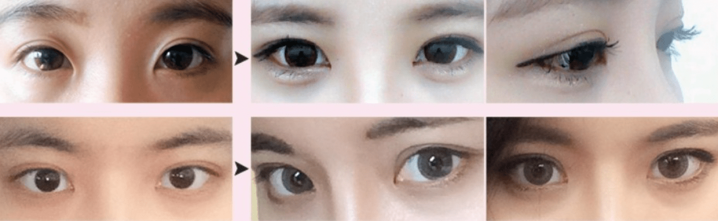 Non-incisional Double Eyelid Surgery  
