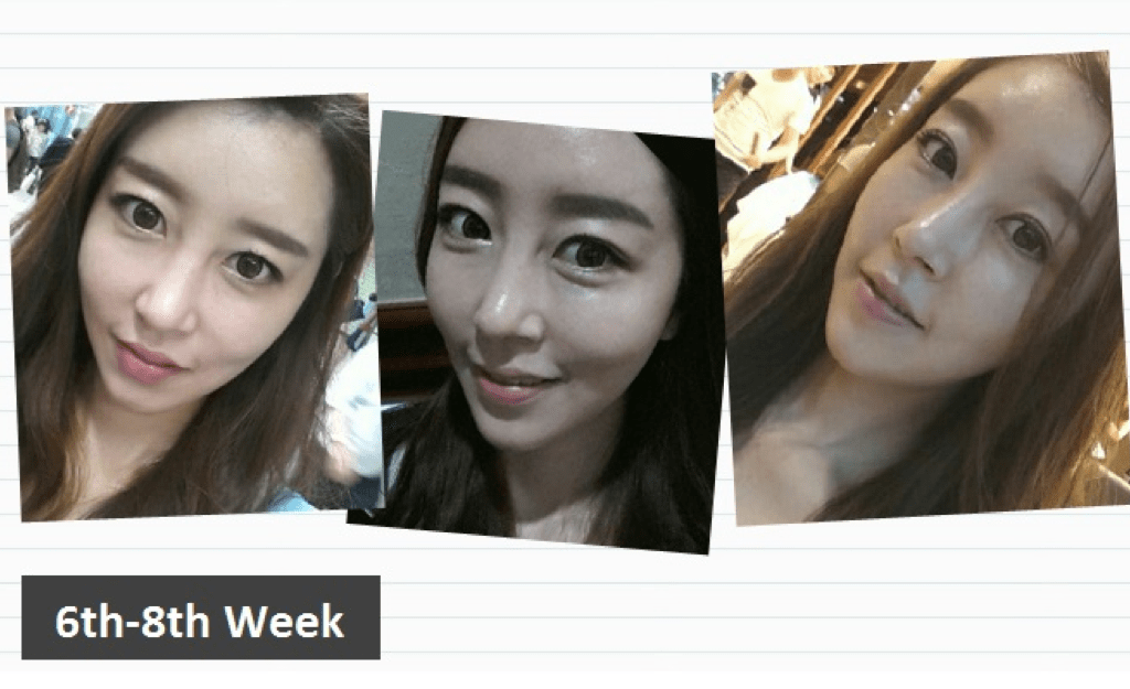 Fat Grafting, Facial Contouring, Rhinoplasty Before & After Fat Grafting, Facial Contouring, Rhinoplasty Before & After