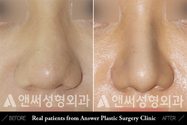 Blunt or Bulbous Tip Correction