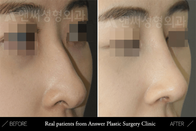 Downward Pointing Tip Correction