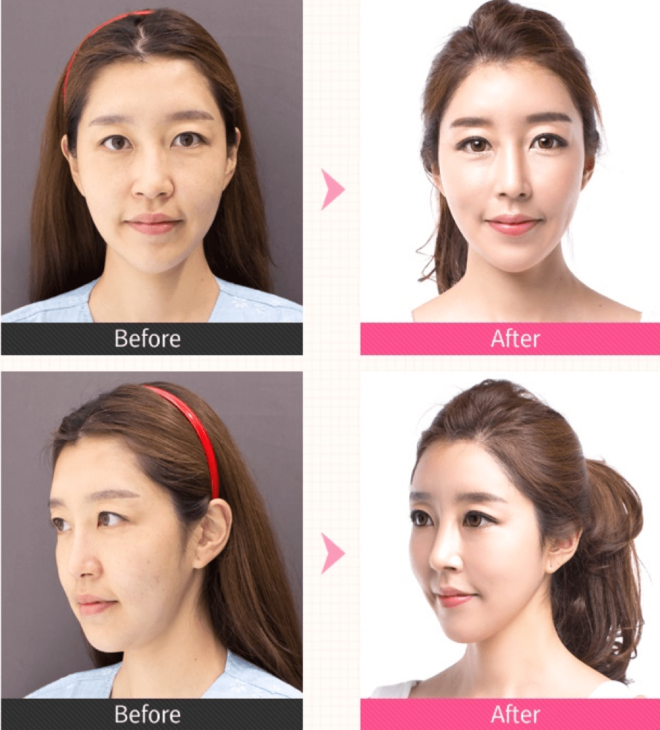 Fat Grafting, Facial Contouring, Rhinoplasty Before & After Fat Grafting, Facial Contouring, Rhinoplasty Before & After