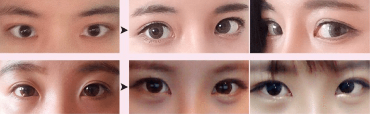 What is Epicanthoplasty - Details of the procedure, Operation Process, Before & After