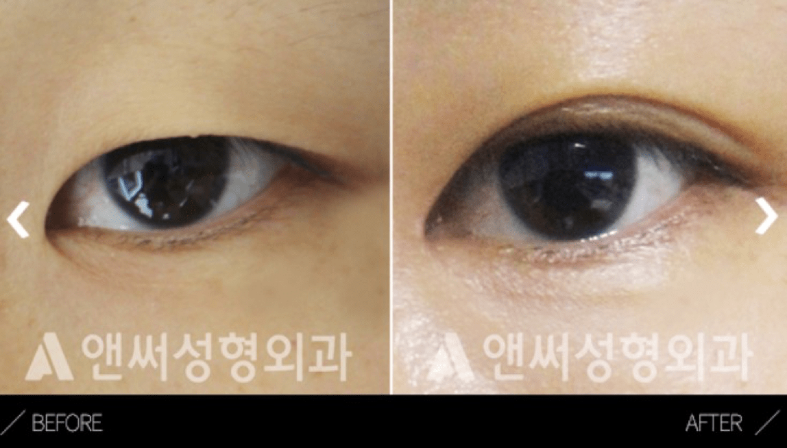 What is Epicanthoplasty - Details of the procedure, Operation Process, Before & After
