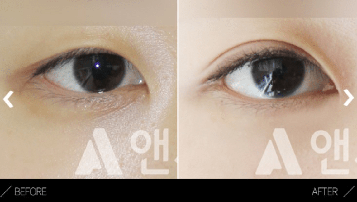 What is Epicanthoplasty - Details of the procedure, Operation Process, Before & After