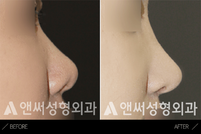 Short Nose Correction