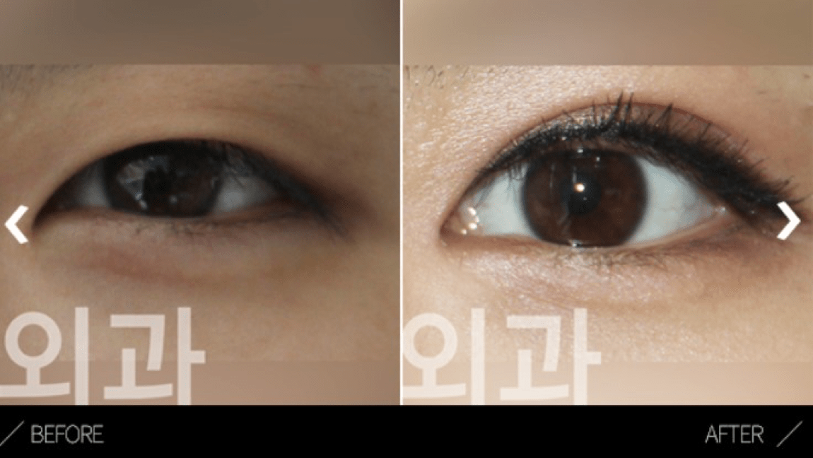 What is Epicanthoplasty - Details of the procedure, Operation Process, Before & After