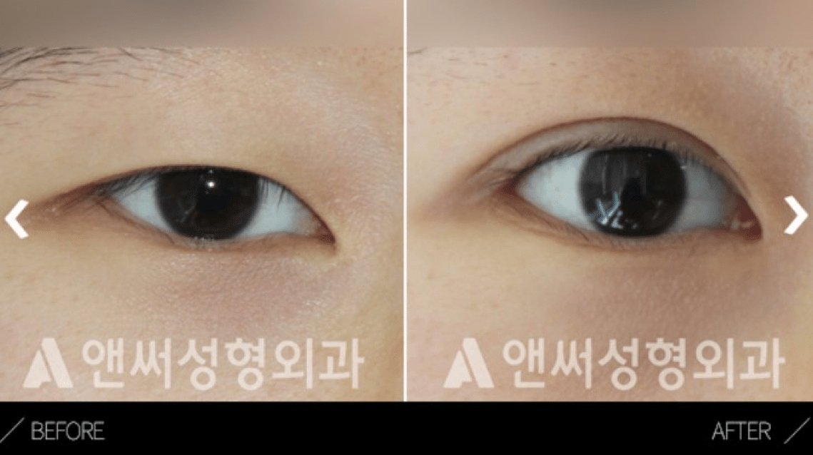 What is Epicanthoplasty - Details of the procedure, Operation Process, Before & After