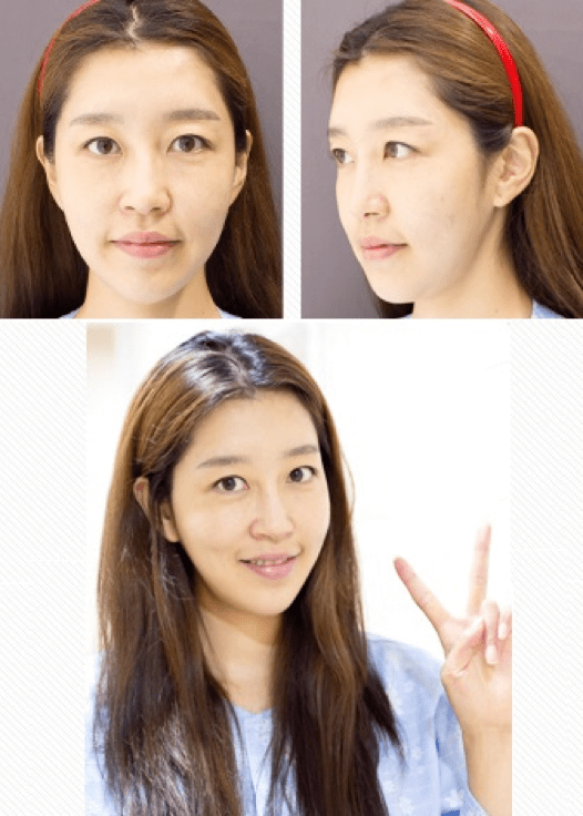 Fat Grafting, Facial Contouring, Rhinoplasty Before & After Fat Grafting, Facial Contouring, Rhinoplasty Before & After